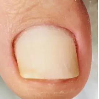 Laserterapia — depois do tratamento